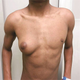 unilateral gynecomastia